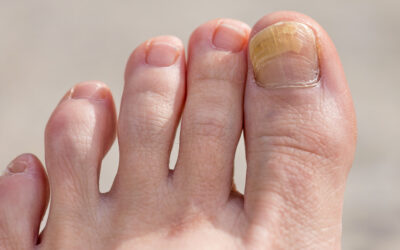 Psoriasis: So äußert sich die Schuppenflechte der Nägel