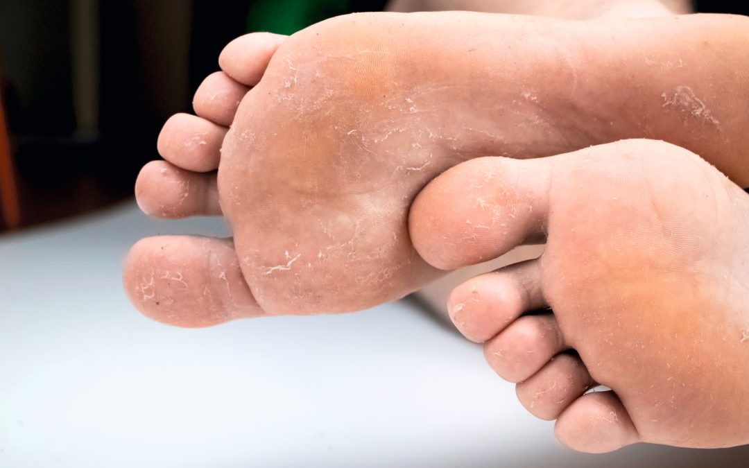 Erfolgreich gegen Mykosen: Haut- und Fußpilze behandeln
