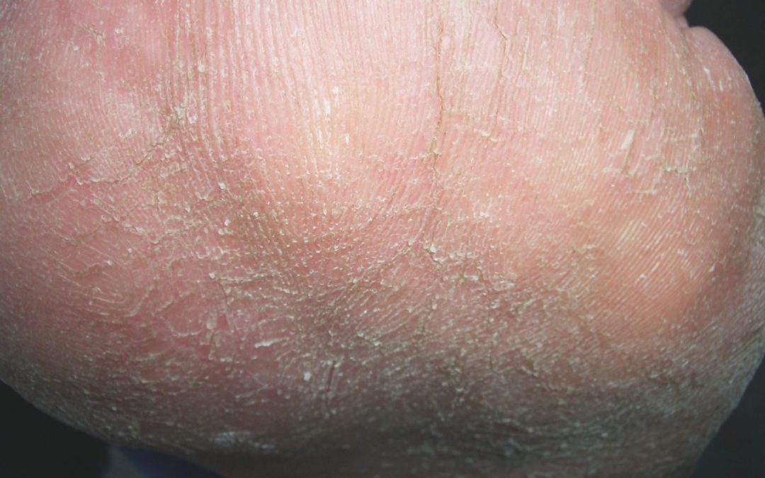 Harmlos, aber störend: Hyperkeratosen