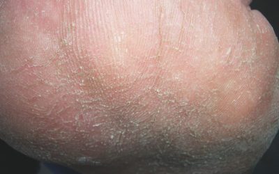 Harmlos, aber störend: Hyperkeratosen