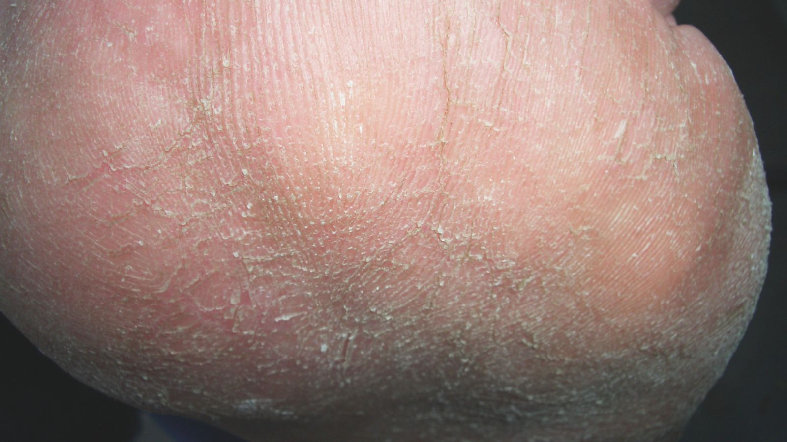 Tipps gegen störende Hornhaut