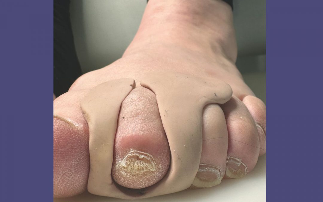 Orthosen: Kleiner Helfer mit großer Wirkung