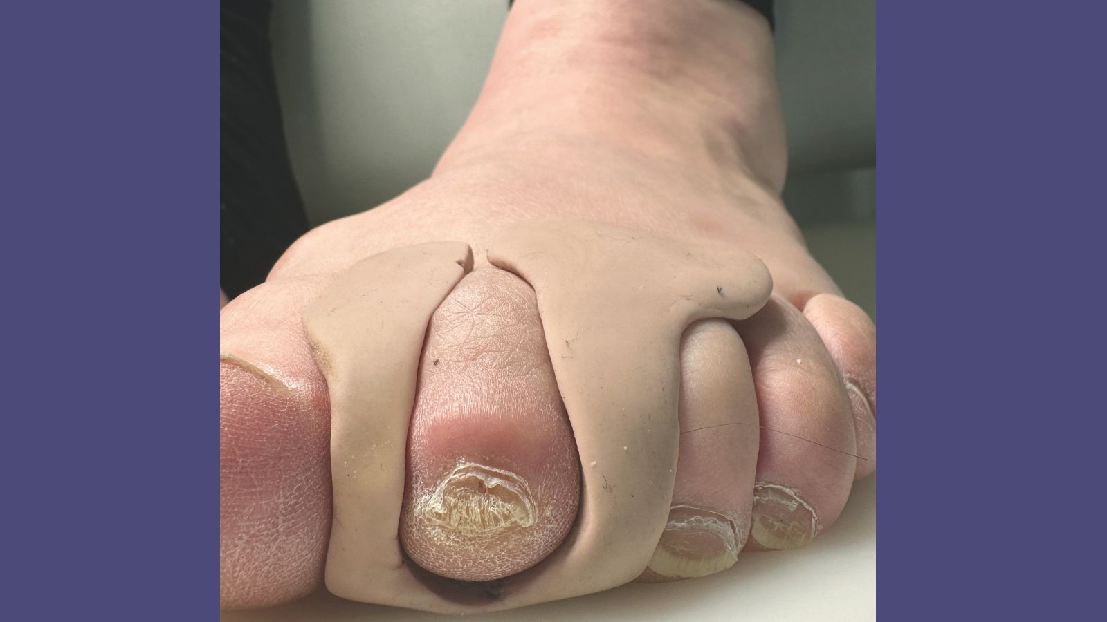 Orthosen am Fuß sind kleine Helfer mit großer Wirkung