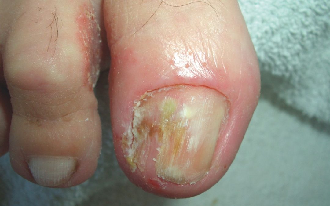 Nagel-Psoriasis: Die Seele leidet mit