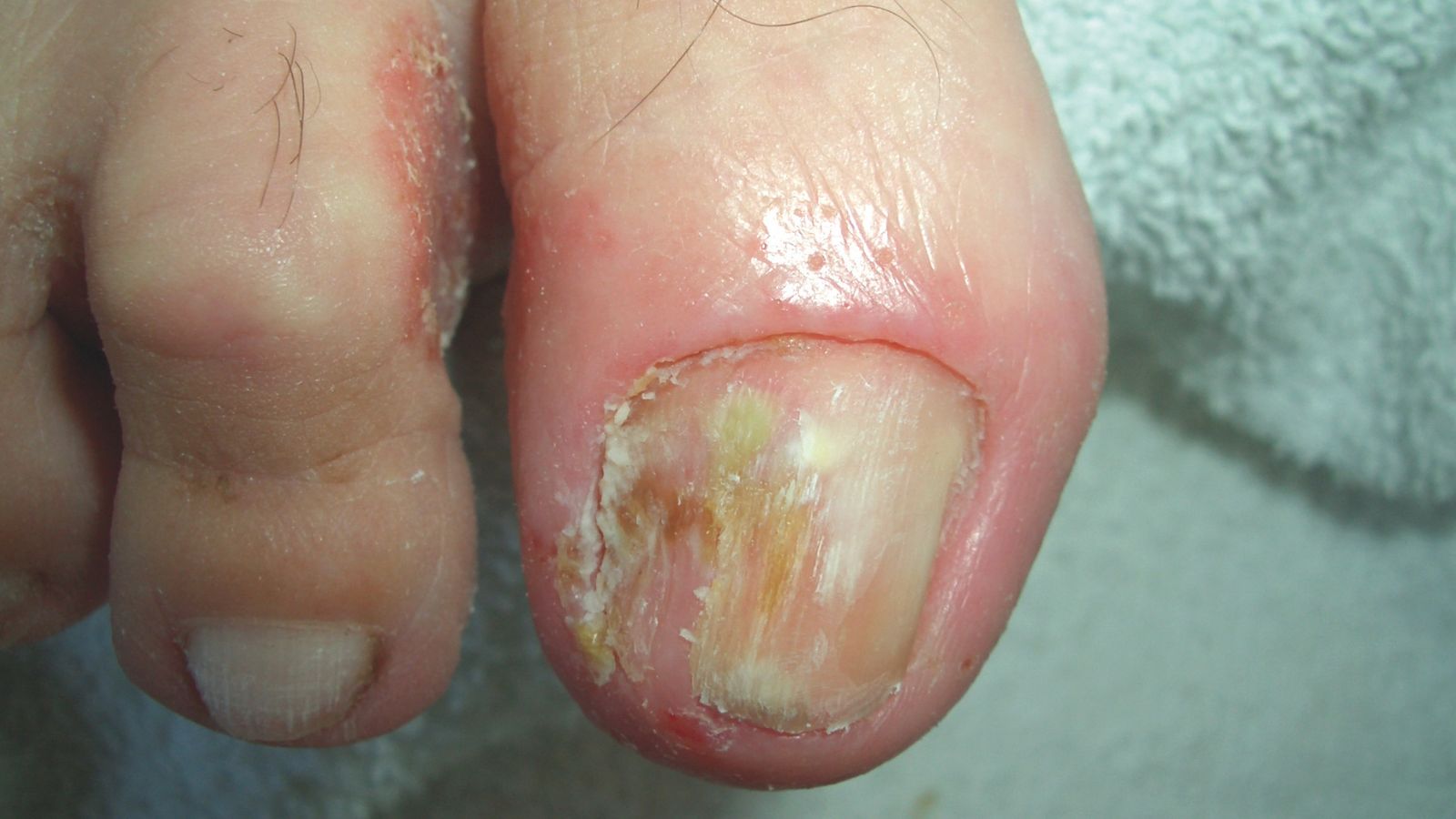Psoriasis tritt auch an den Nägeln auf