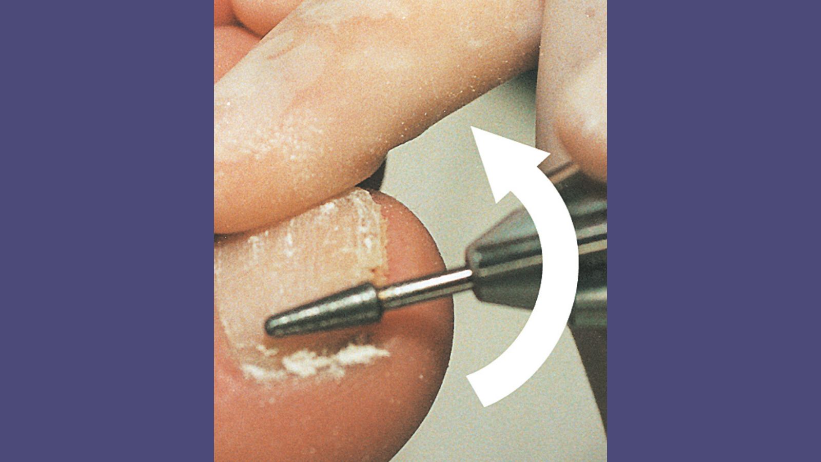 Rotierende Instrumente in der Podologie