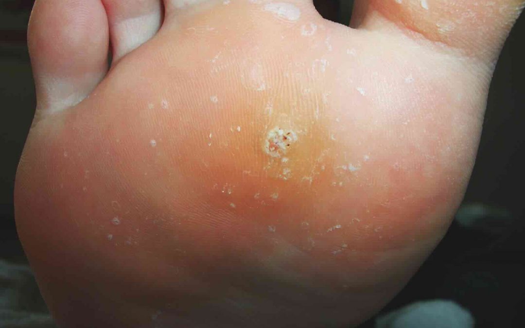 Warzen: Maßnahmen gegen die kleinen Quälgeister