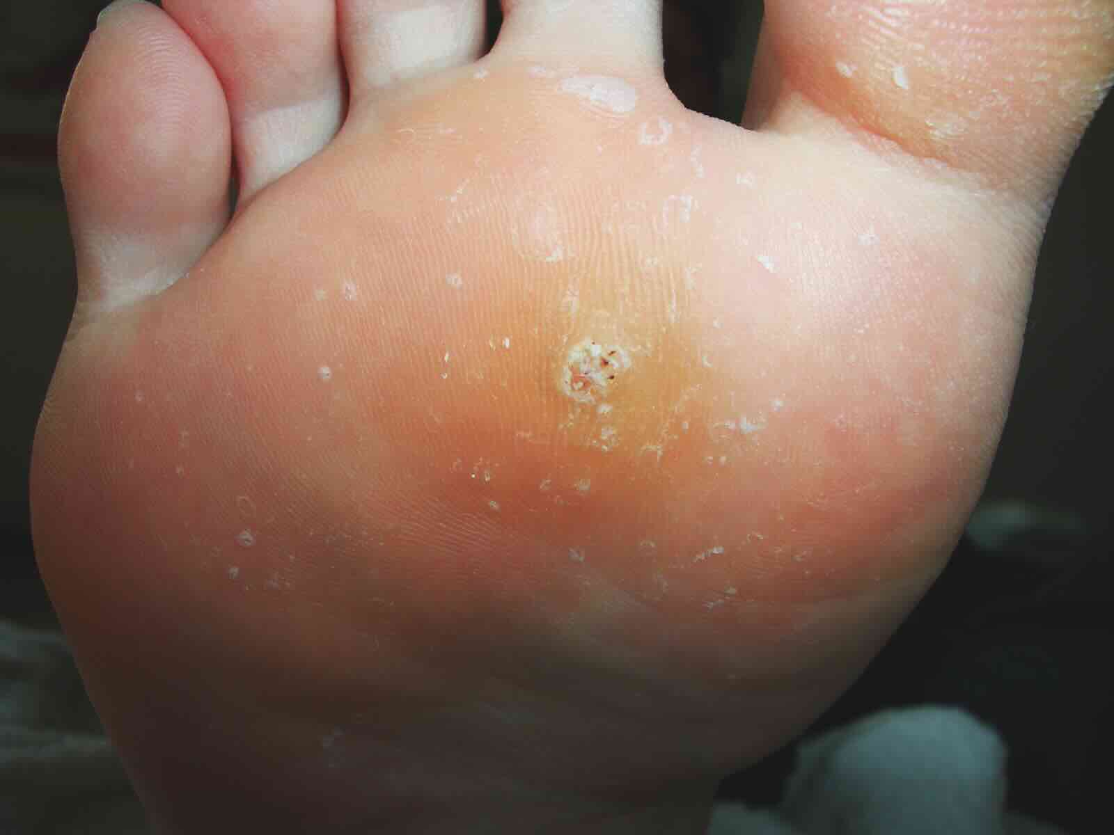 Warzen warzen-richtig-behandeln